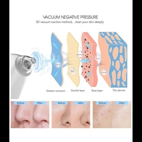 NIB Blackhead Remover 5V Vacuum Portable Blackhead Electric Wireless Recharge - Picture 4 of 8